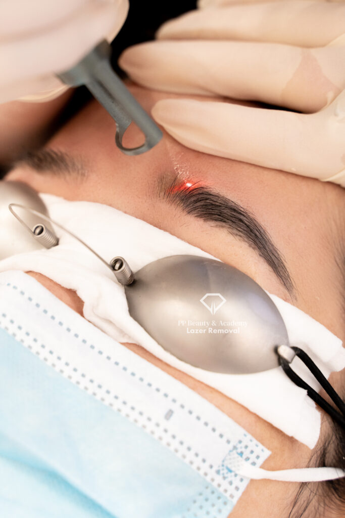 Brow Laser Removal
